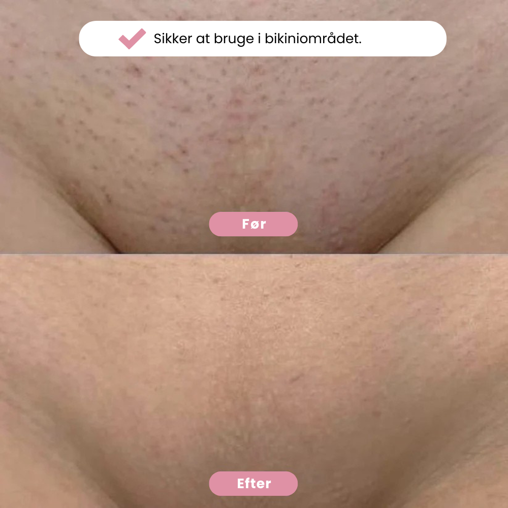 Eulyte™ Bikintrimmer