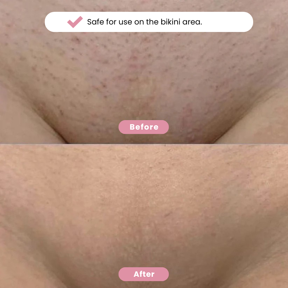 Eulyte™ Bikini Trimmer